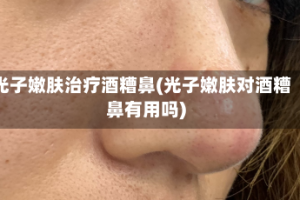光子嫩肤治疗酒糟鼻(光子嫩肤对酒糟鼻有用吗)