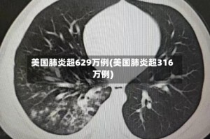 美国肺炎超629万例(美国肺炎超316万例)