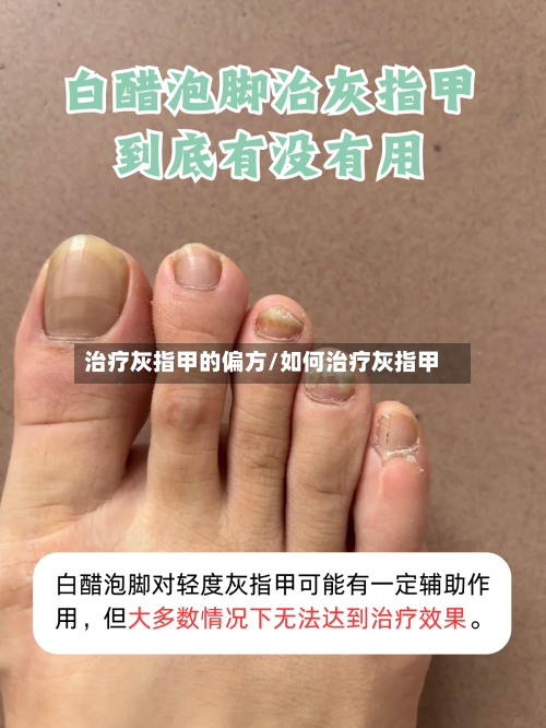 治疗灰指甲的偏方/如何治疗灰指甲-第2张图片