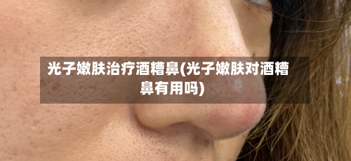光子嫩肤治疗酒糟鼻(光子嫩肤对酒糟鼻有用吗)-第1张图片